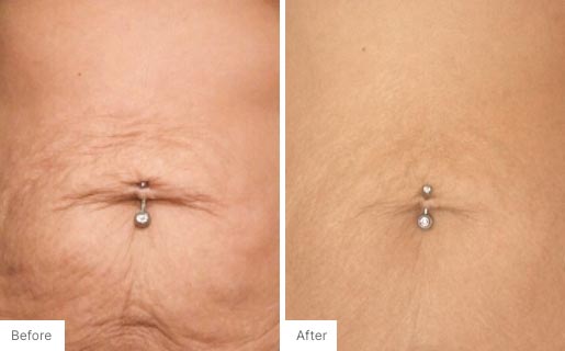 2 - Before and After Real Results photo of someone's stomach.